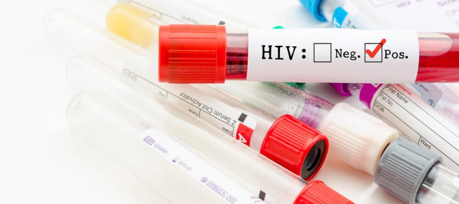 Aids Testi Nedir?