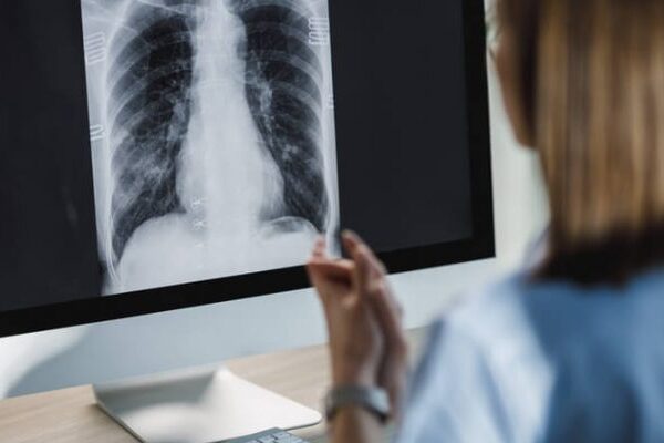 Akciğer Tomografisi