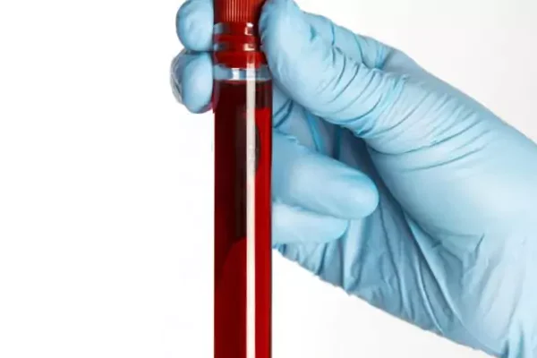 Bilirubin Direkt Testi