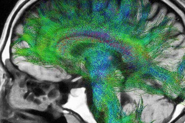 MR Tensör ve Traktografi