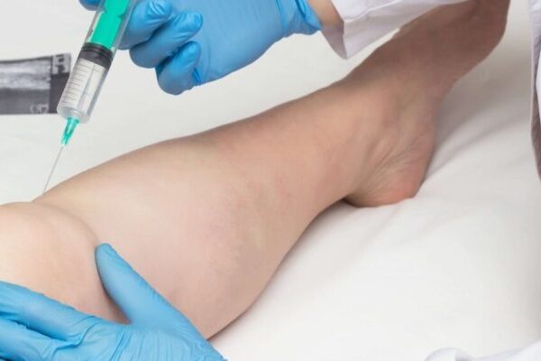 Proloterapi (Şekerli Su Tedavisi)