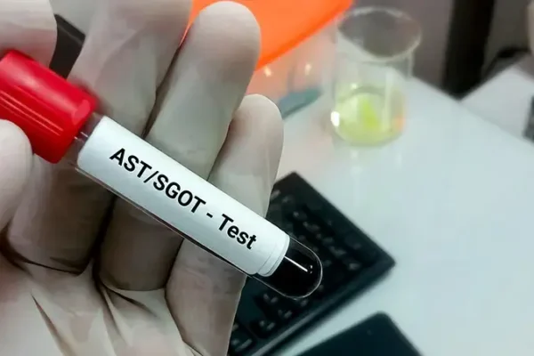SGOT (AST) Testi