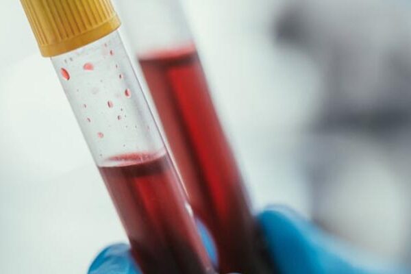 Protrombin Zamanı Testi