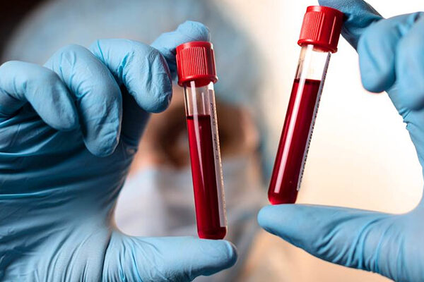 Bilirubin Total Testi