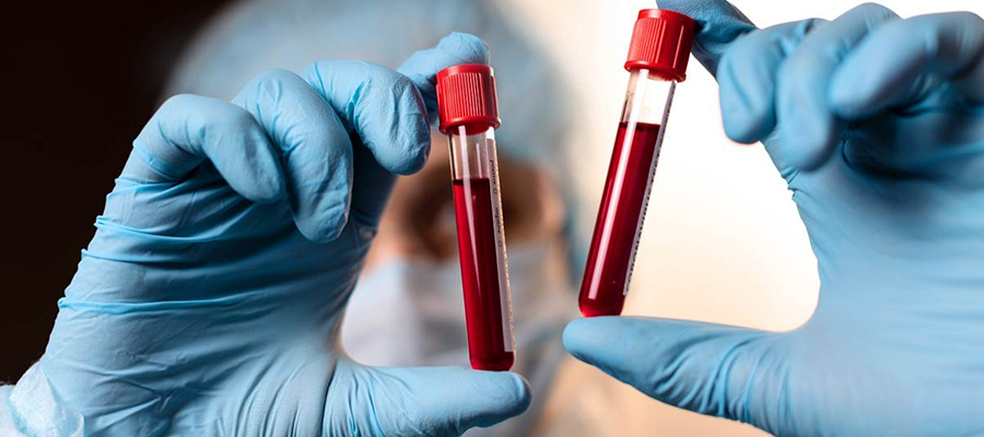 Bilirubin Total Testi