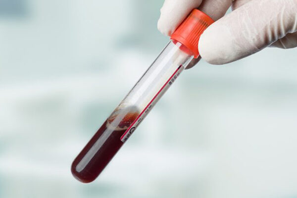 Akdeniz Ateşi (FMF testi)