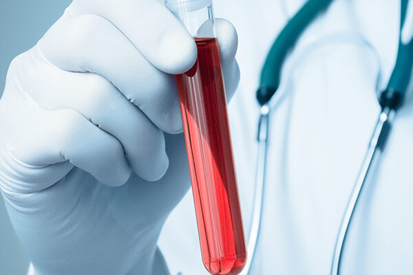 Faktör II Protrombin Testi