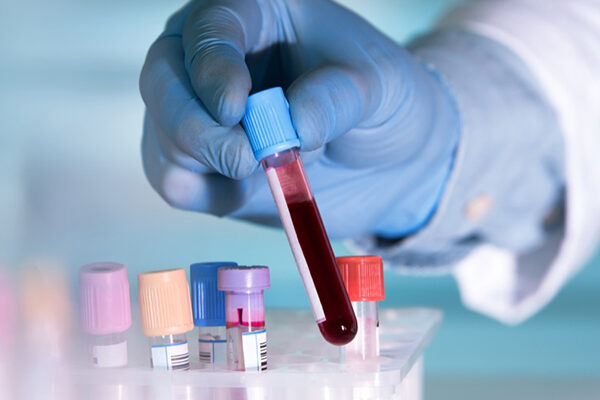 Alkalen Fosfataz Testi