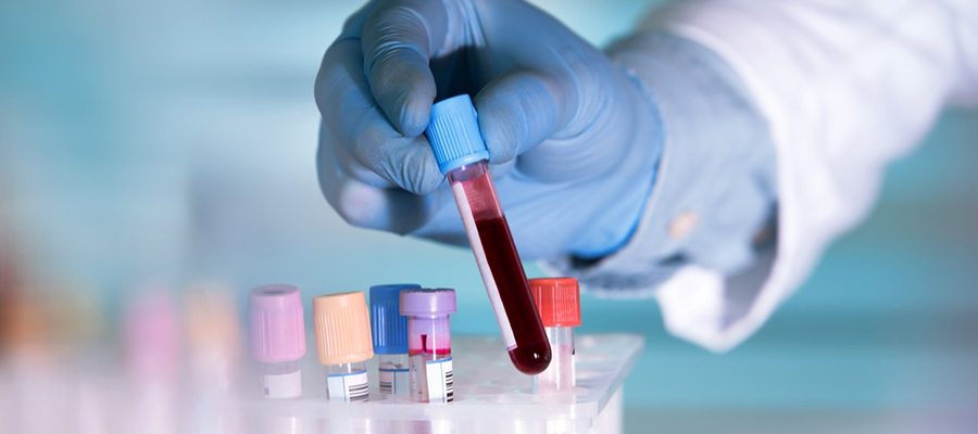 Alkalen Fosfataz Testi