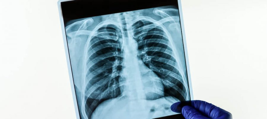 Thorax Tomografi