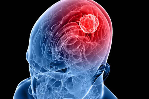 Transfontanel Ultrason