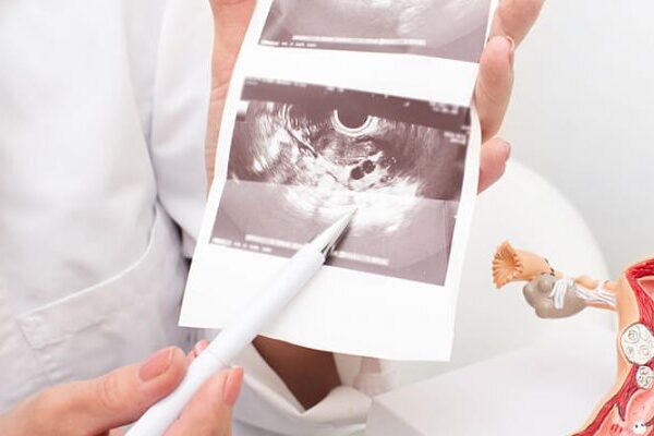 Transvajinal Ultrasonografi