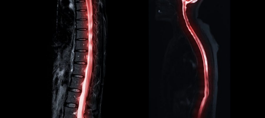 Tüm Spinal MR